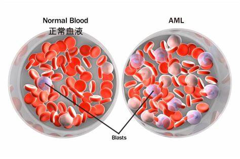 ivosidenib (Tibsovo)联合阿扎胞苷治疗新诊断的IDH1突变型AML获FDA批准_香港济民药业