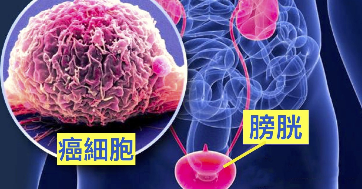 N-803+BCG治疗BCG无反应的非肌层浸润性原位膀胱癌在FDA进入审查_香港济民药业