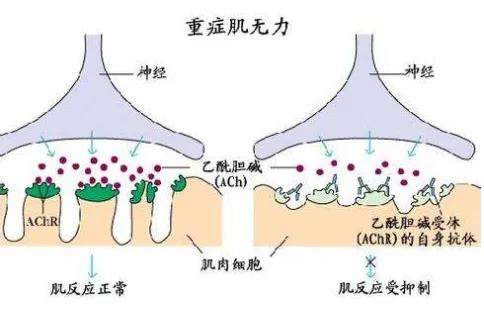 Ultomiris(ravulizumab)在欧盟获批用于成人全身性重症肌无力_香港济民药业