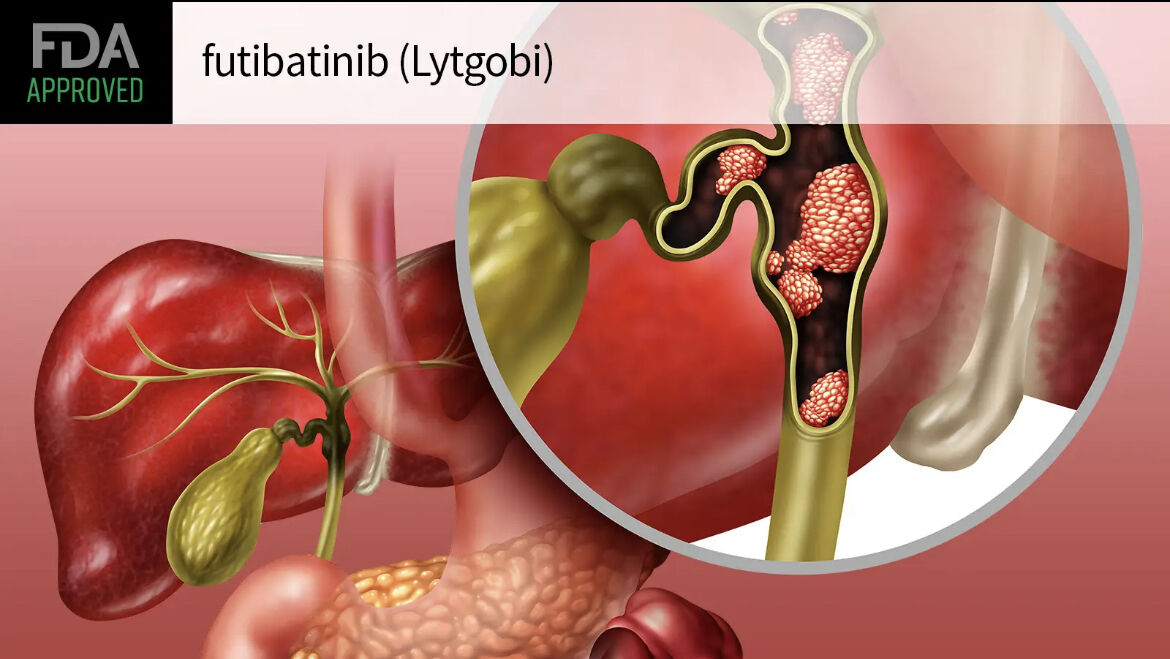Lytgobi(futibatinib)治疗肝内胆管细胞癌中文说明书-价格-适应症-不良反应及注意事项