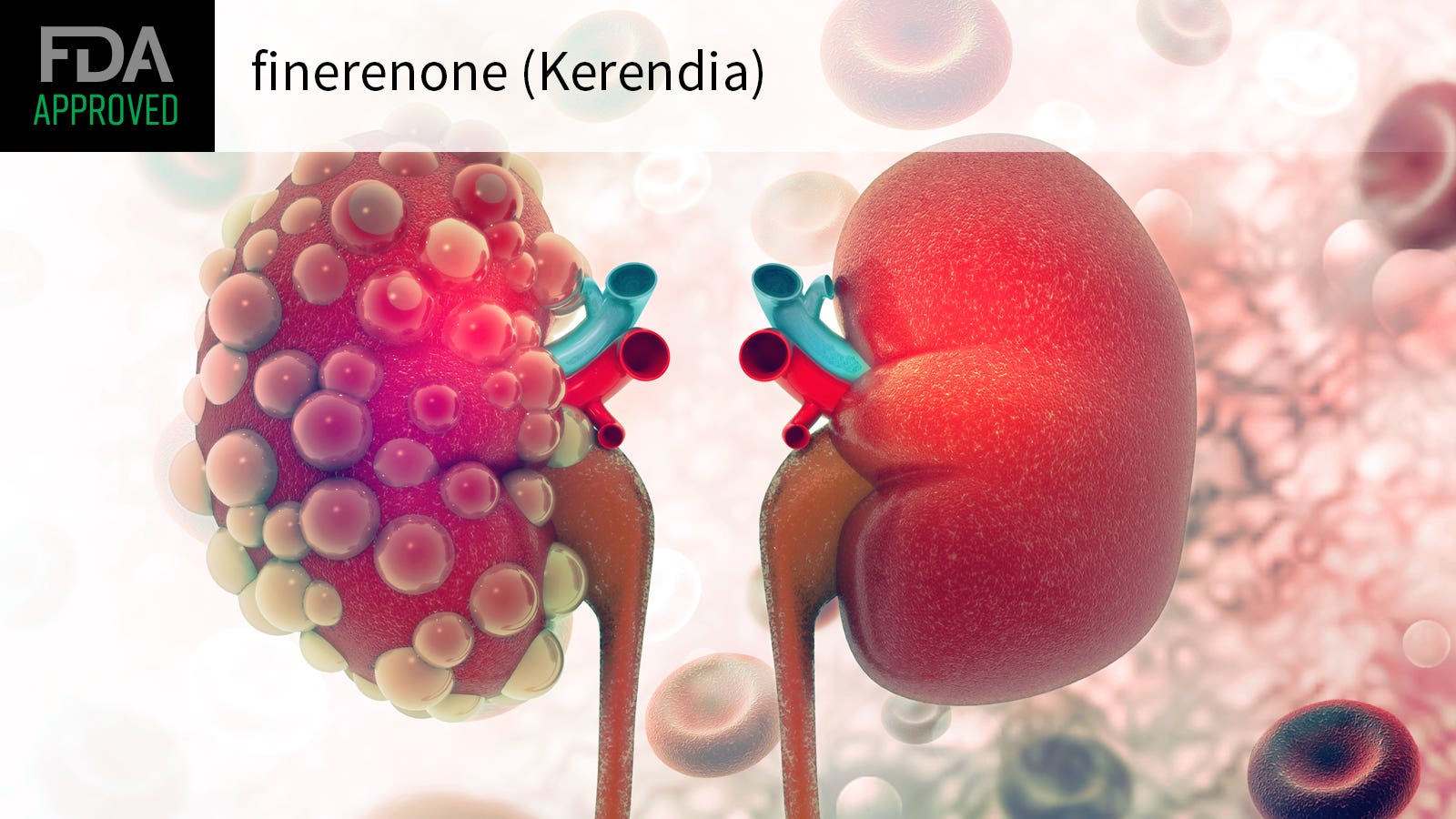 加拿大批准KERENDIA (Finerenone)作为糖尿病肾病成人标准护理治疗的辅助药物_香港济民药业