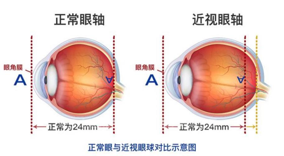 近视除了遗传因素影响外还和什么有关？使用0.01%阿托品真的有效！_香港济民药业