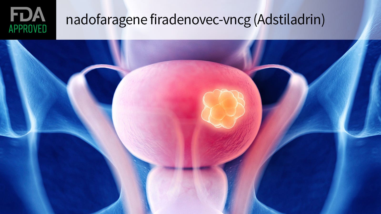 首个膀胱癌基因疗法！Adstiladrin(nadofaragene firadenovec-vncg)获FDA批准_香港济民药业