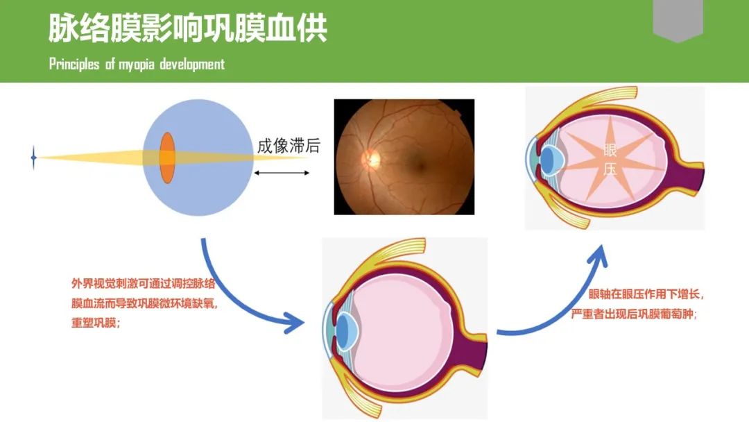 脉络膜和近视有什么关系，使用0.01%阿托品有用吗？_香港济民药业