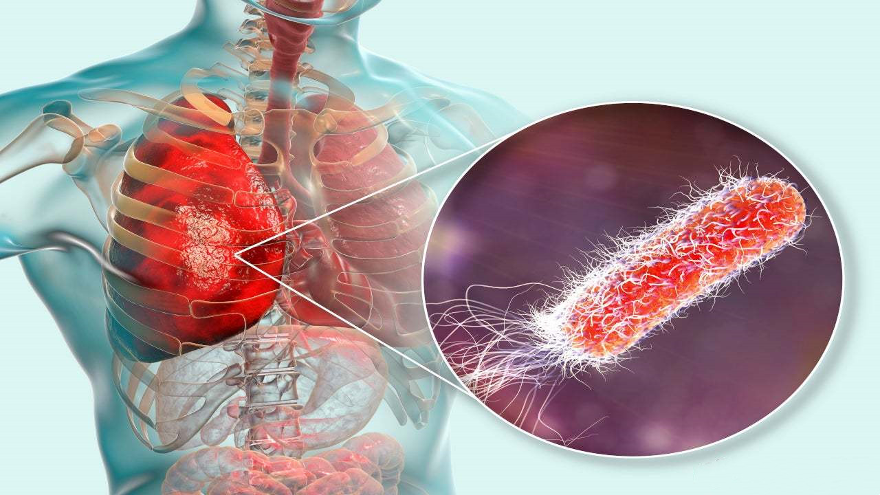 细菌性肺炎药物Fetroja（cefiderocol）的作用机制、疗效及安全性_香港济民药业