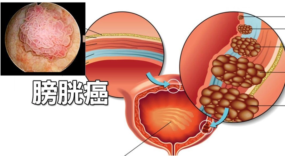 尿路上皮癌一线治疗新方案：FDA加速批准Padcev+pembrolizumab联合用药_香港济民药业