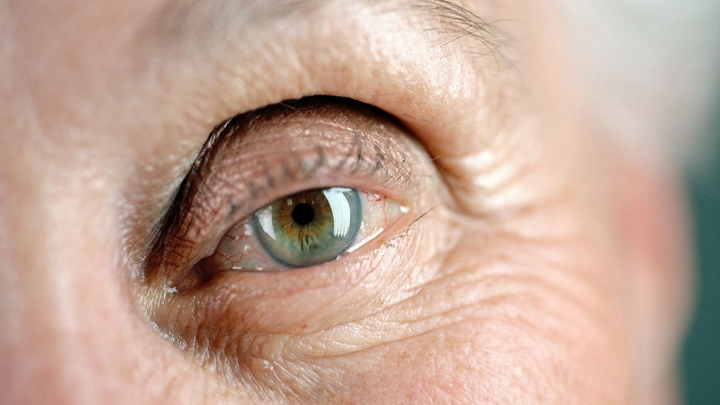 Vabysmo第三种适应症！FDA接受Vabysmo用于视网膜静脉阻塞后黄斑水肿的申请