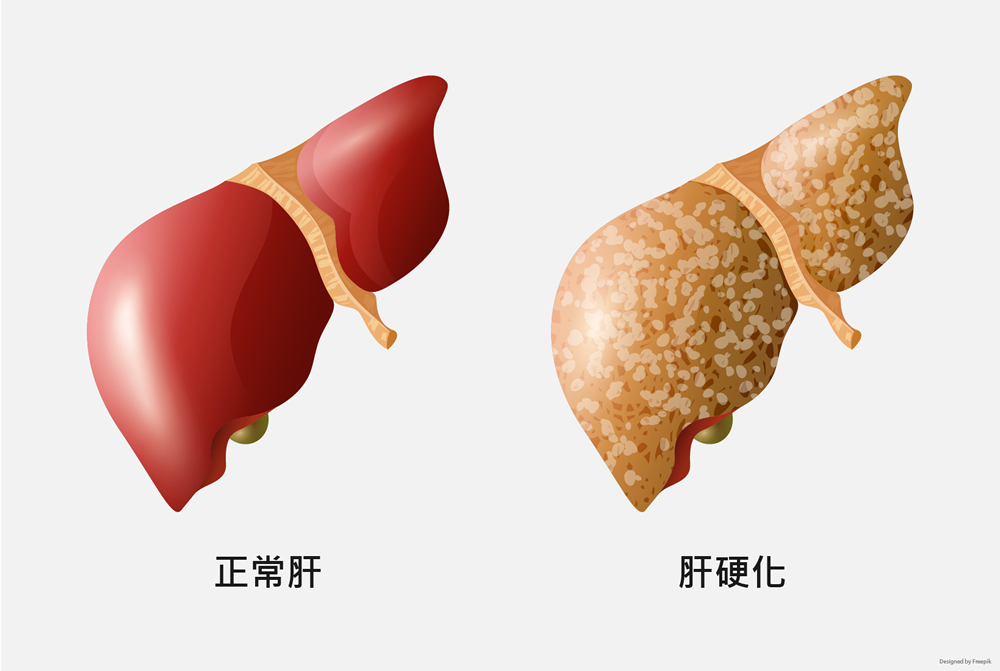 FDA胃肠药物咨询委员会投票支持了OCA治疗NASH引起的肝硬化前纤维化_香港济民药业