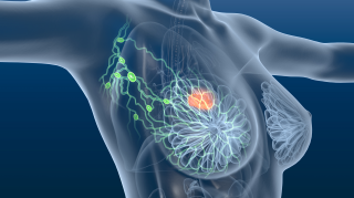 HR阳性乳腺癌治疗新选择！Capivasertib联合氟维司群获FDA优先审查