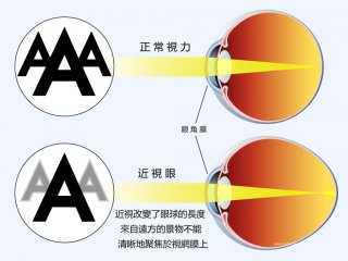 导致近视的原因有多种，如何控制儿童近视？