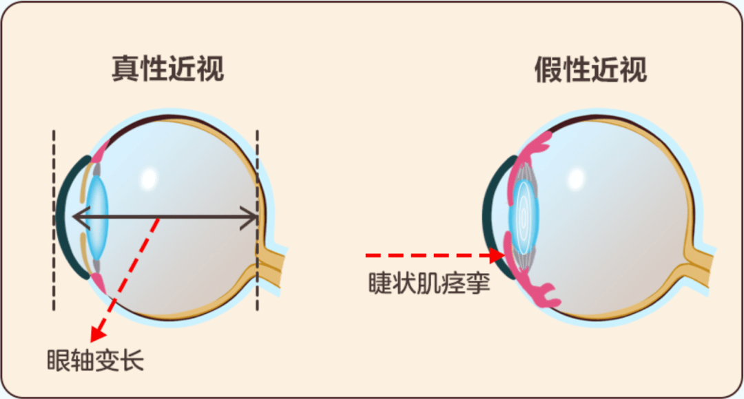 孩子患上假性近视怎么办？用善瞳滴眼液可缓解_香港济民药业