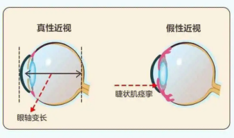 假性近视如何治愈？0.01%阿托品可行吗？_香港济民药业