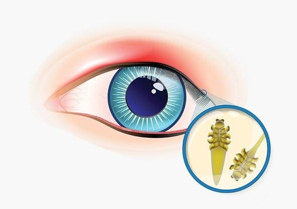 蠕形螨性睑缘炎首个治疗方法XDEMVY(lotilaner滴眼液)现已在美上市_香港济民药业