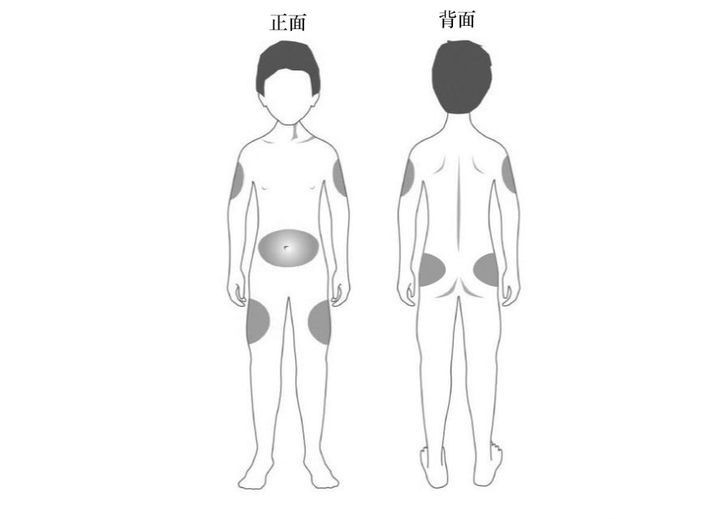 低磷酸酯酶症药物Strensiq使用说明：用量、配置和注射教程_香港济民药业