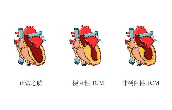 新证据、指南支持玛伐凯泰/Mavacamten用于肥厚型心肌病_香港济民药业
