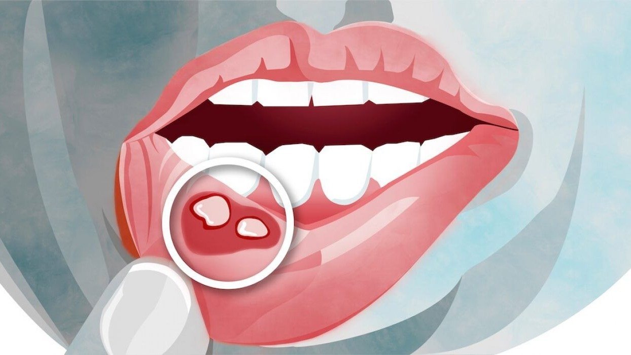 口腔溃疡新治疗选择、Kourzeq口腔牙膏已被推出市场_香港济民药业