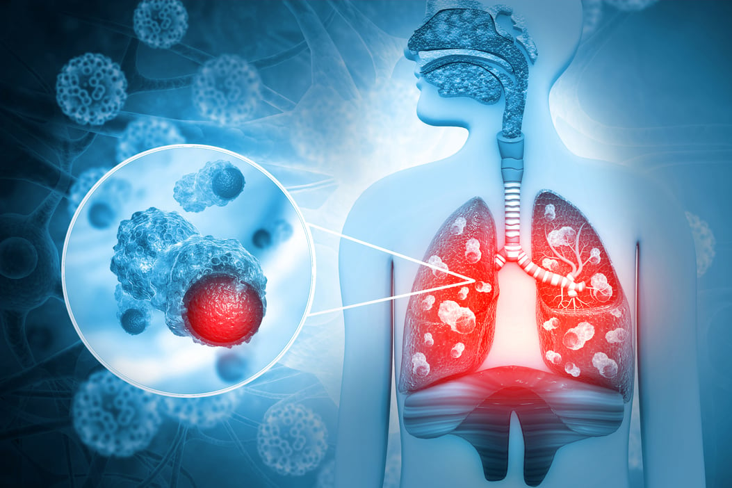 晚期小细胞肺癌潜在新药！安进Tarlatamab获FDA优先审查