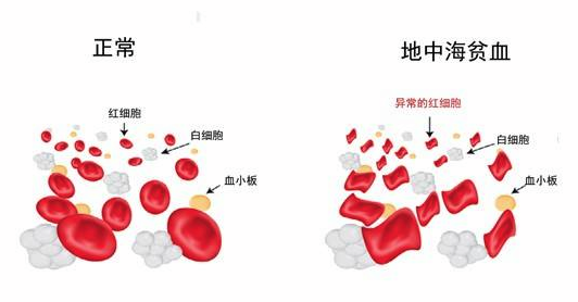 Mitapivat有望成为首个非输血依赖性地中海贫血的口服疗法_香港济民药业