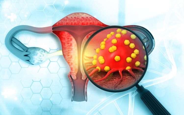Keytruda联合放化疗获批用于FIGO 2014年III-IVA期宫颈癌