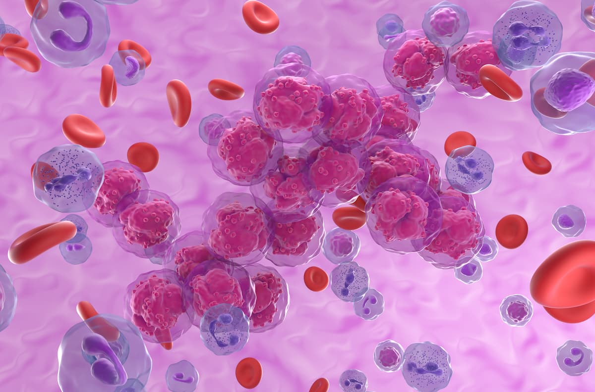 复发/难治性B细胞急性淋巴细胞白血病潜在疗法Obe-cel在FDA进入审查