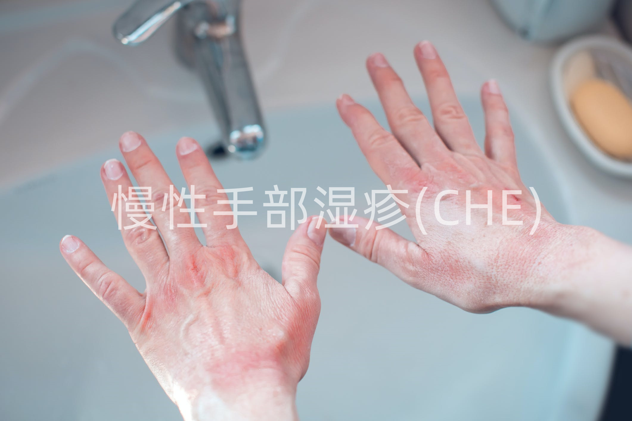 慢性手部湿疹新型疗法！delgocitinib乳膏在头对头研究中取得积极结果_香港济民药业