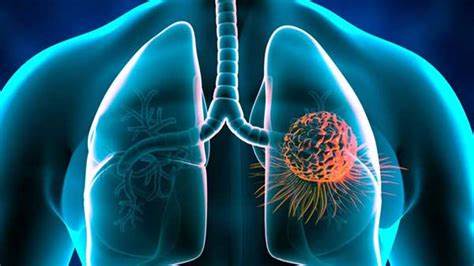 Tagrisso联合化疗在美国获批用于治疗EGFR突变的晚期肺癌患者