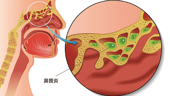 XHANCE（丙酸氟替卡松）鼻喷雾剂获批用于治疗不伴有鼻息肉的慢性鼻窦炎