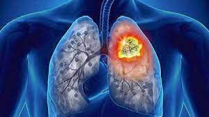 Keytruda疗法获得欧盟委员会批准扩大用于围手术期肺癌的治疗