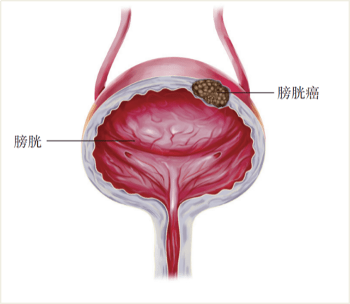 非肌层浸润性膀胱癌组合疗法！Anktiva联合卡介苗在美获批_香港济民药业