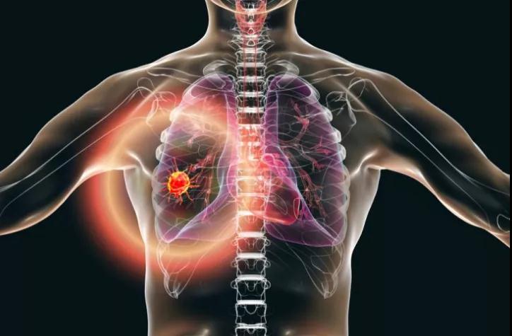 Ensacove获FDA批准用于治疗ALK阳性的局部晚期或转移性NSCLC_香港济民药业