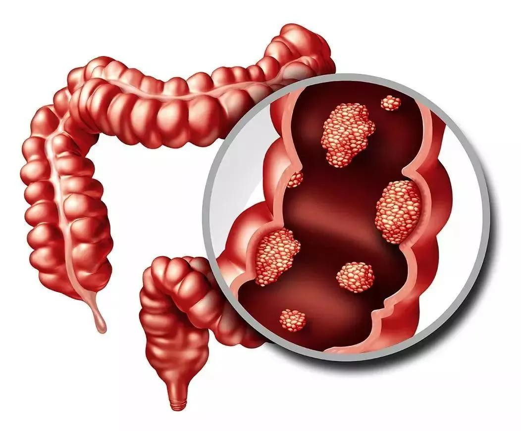 β-连环蛋白拮抗剂ST316被指定为治疗家族性腺瘤性息肉病的孤儿药