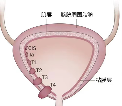 膀胱癌基因疗法ADSTILADRIN在日本患者中实现高完全缓解率