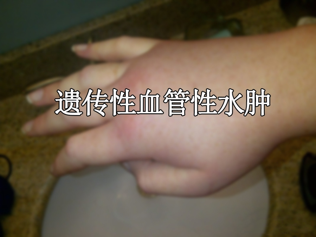 儿科遗传性血管性水肿药物Berotralstat获FDA优先审查_香港济民药业