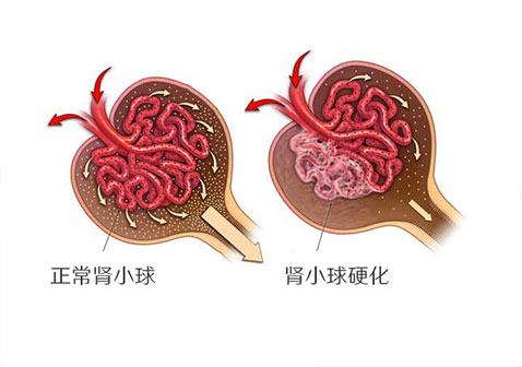局灶性节段性肾小球硬化症新药Sparsentan在美接受监管审查_香港济民药业