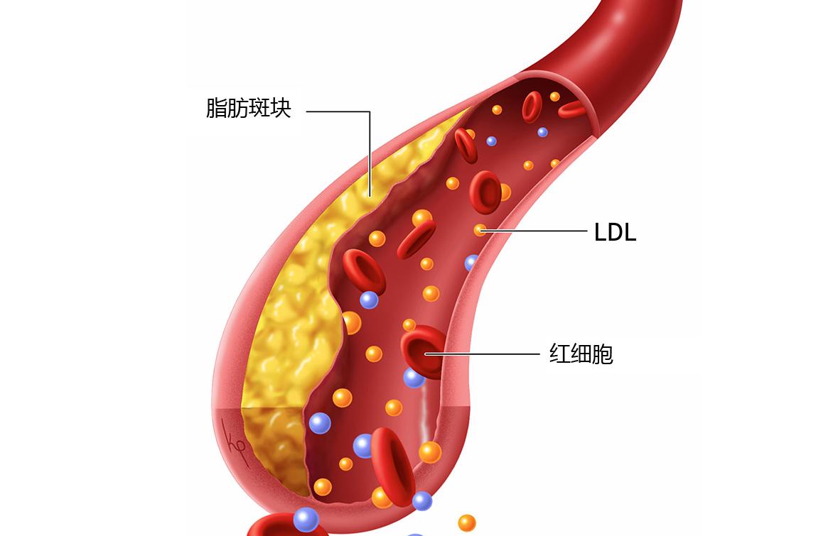 Juxtapid在美获准用于治疗2岁及以上纯合子家族性高胆固醇血症患儿