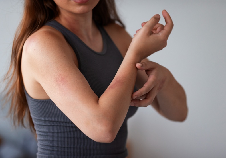 皮肌炎首款靶向疗法brepocitinib在美国FDA接受审查