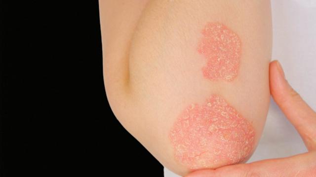 口服多肽疗法Icotyde在美获批用于治疗中重度斑块状银屑病