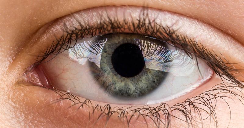 介入性圆锥角膜新型疗法Epioxa在美国上市