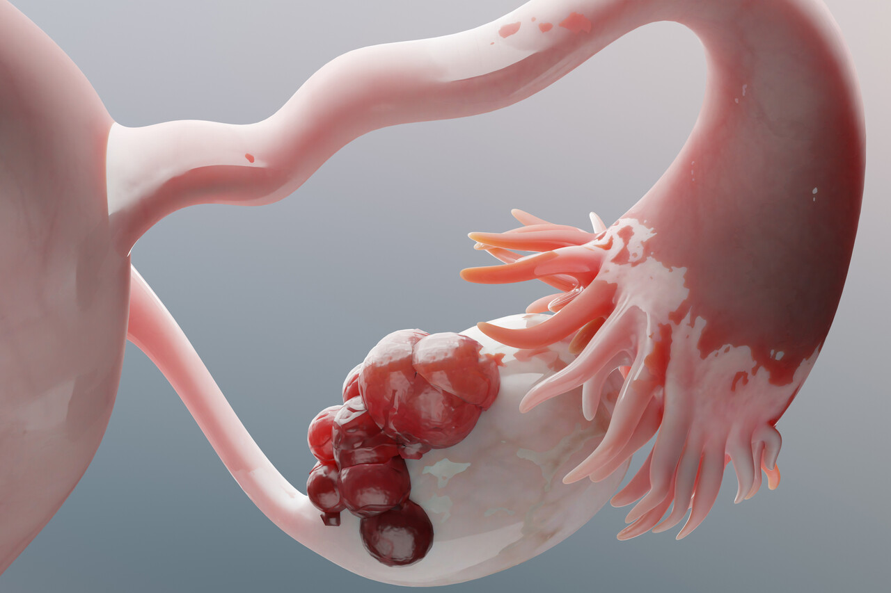 Lifyorli联合白蛋白紫杉醇在美获批用于治疗铂类耐药卵巢癌