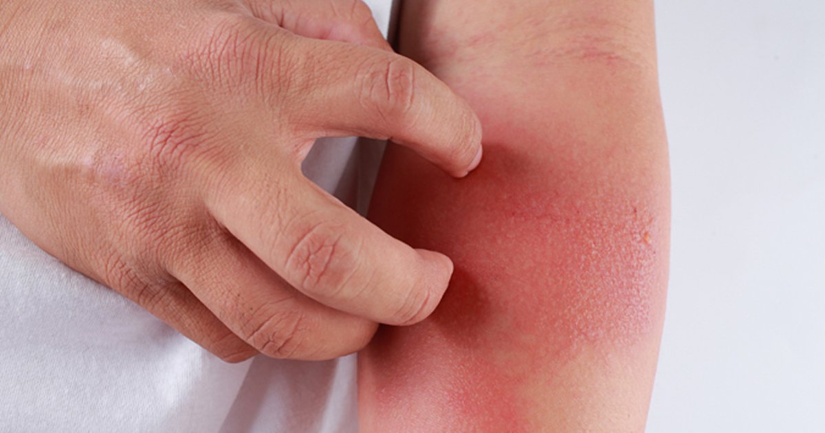 Lynavoy(linerixibat)中文说明书-价格-适应症-不良反应及注意事项