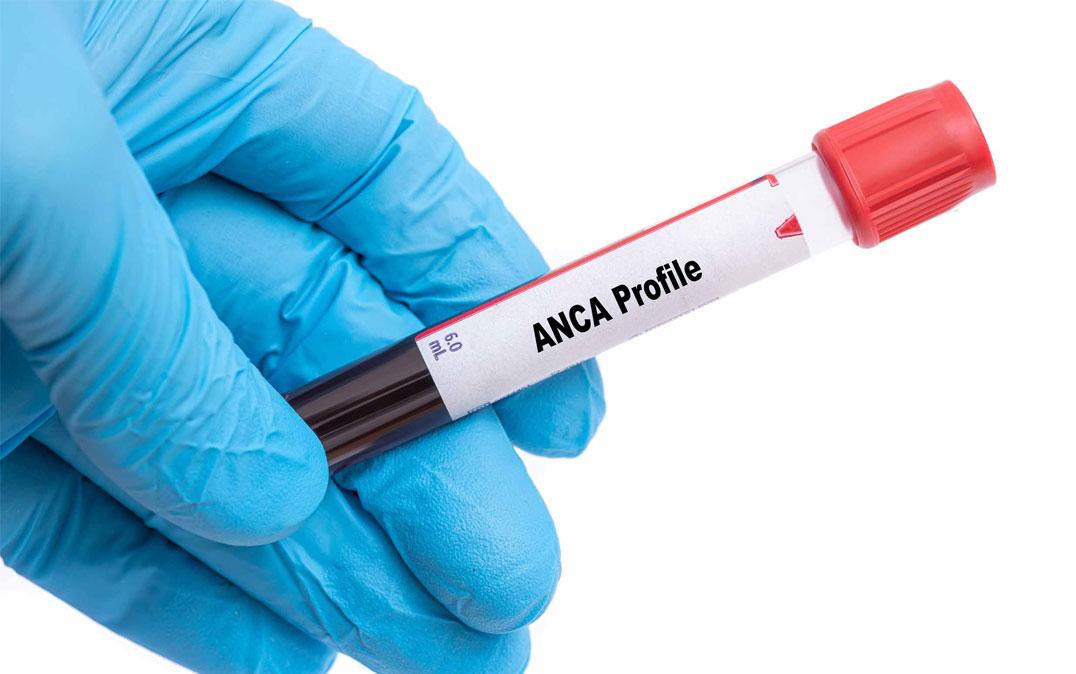 FDA发布关于使用Tavneos可能导致肝损伤的安全警示_香港济民药业