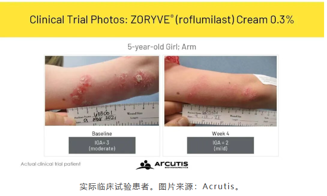 Zoryve 0.3%乳膏用于斑块状银屑病扩大适用年龄涵盖低至2岁_香港济民药业