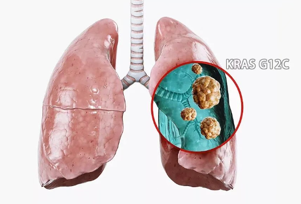 新一代KRAS靶向药Divarasib在肺癌3期试验中优于现有同类药物_香港济民药业
