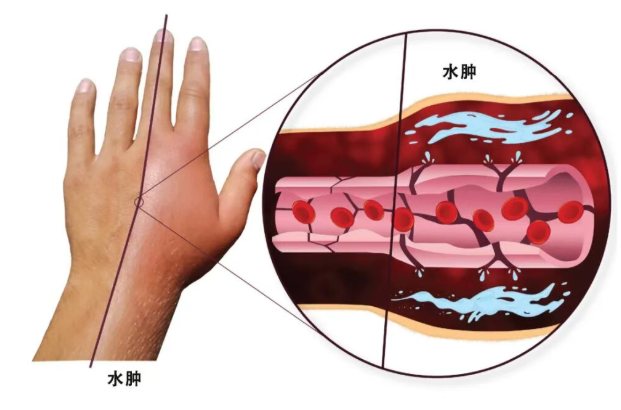 HAE按需治疗潜在口服新药：FDA已受理速释型Deucrictibant新药申请_香港济民药业