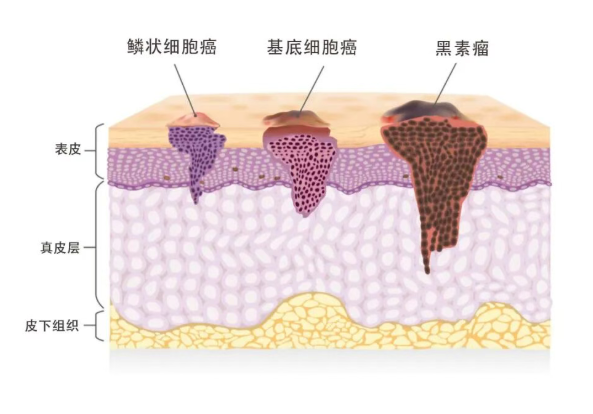 涂药+照光！Ameluz凝胶美国获批治疗浅表基底细胞癌_香港济民药业