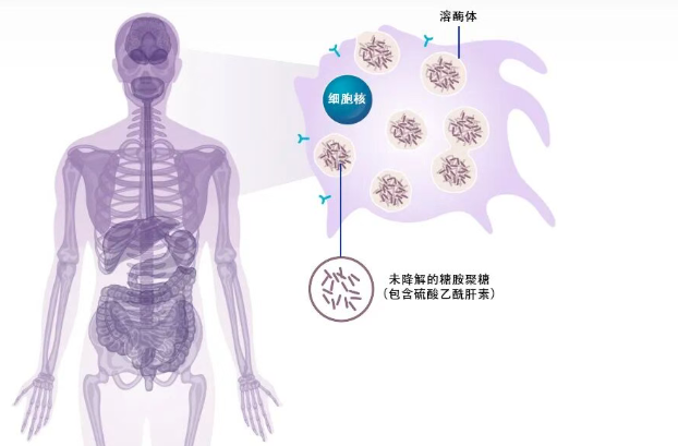 黏多糖贮积症IIIA型首个基因疗法！FDA批准FAYUVI_香港济民药业