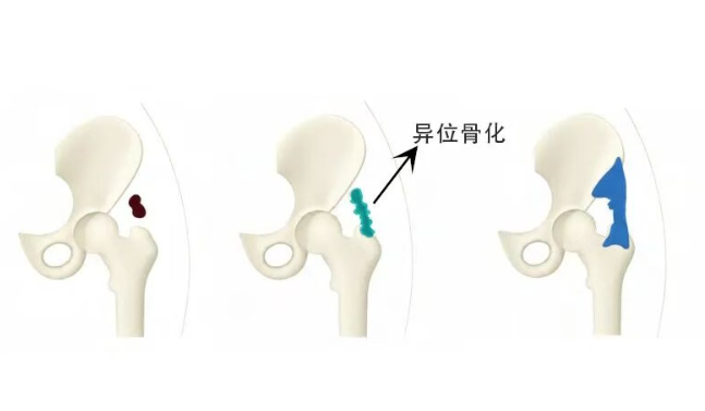 进行性骨化性肌炎新药Pasatru试验84周数据支持用于长期控制疾病_香港济民药业