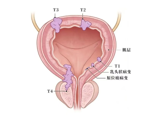 非肌层浸润性膀胱癌新药Anktiva适用范围在美扩大至乳头状病变患者_香港济民药业